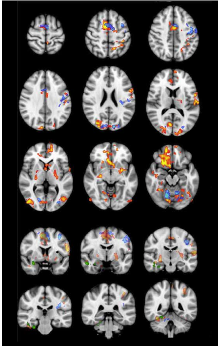 Forskning på Acem-meditasjon - en oversikt